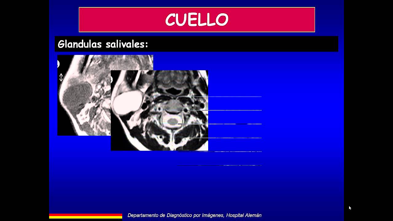 UDH cuello carrera
