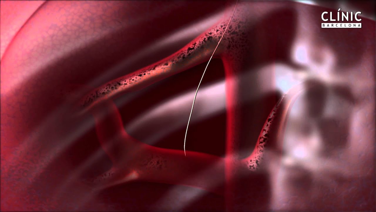 Hospital Clínic Hemodinámica Hepàtica: Técnica TIPS