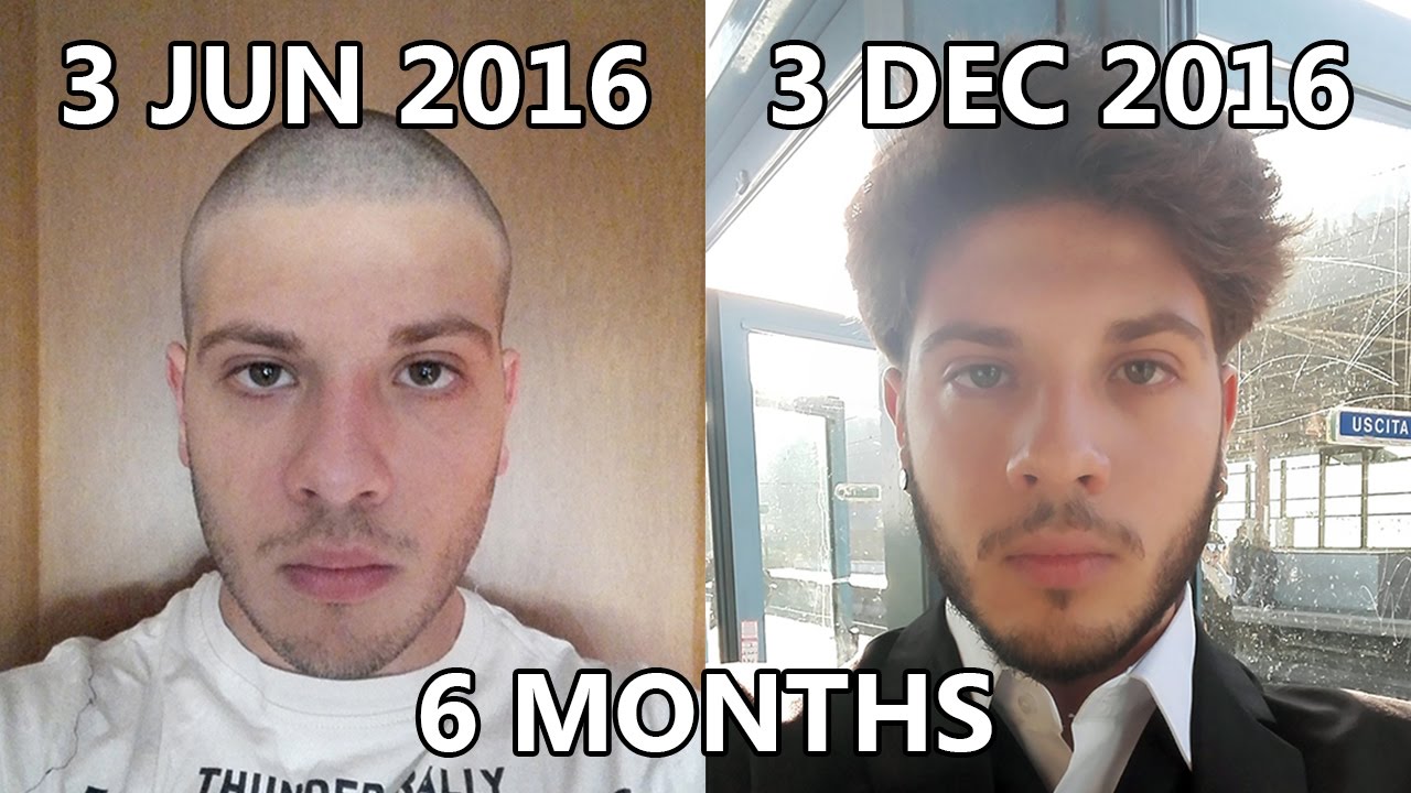 Top Hair Growth Time Lapse - 6 Months