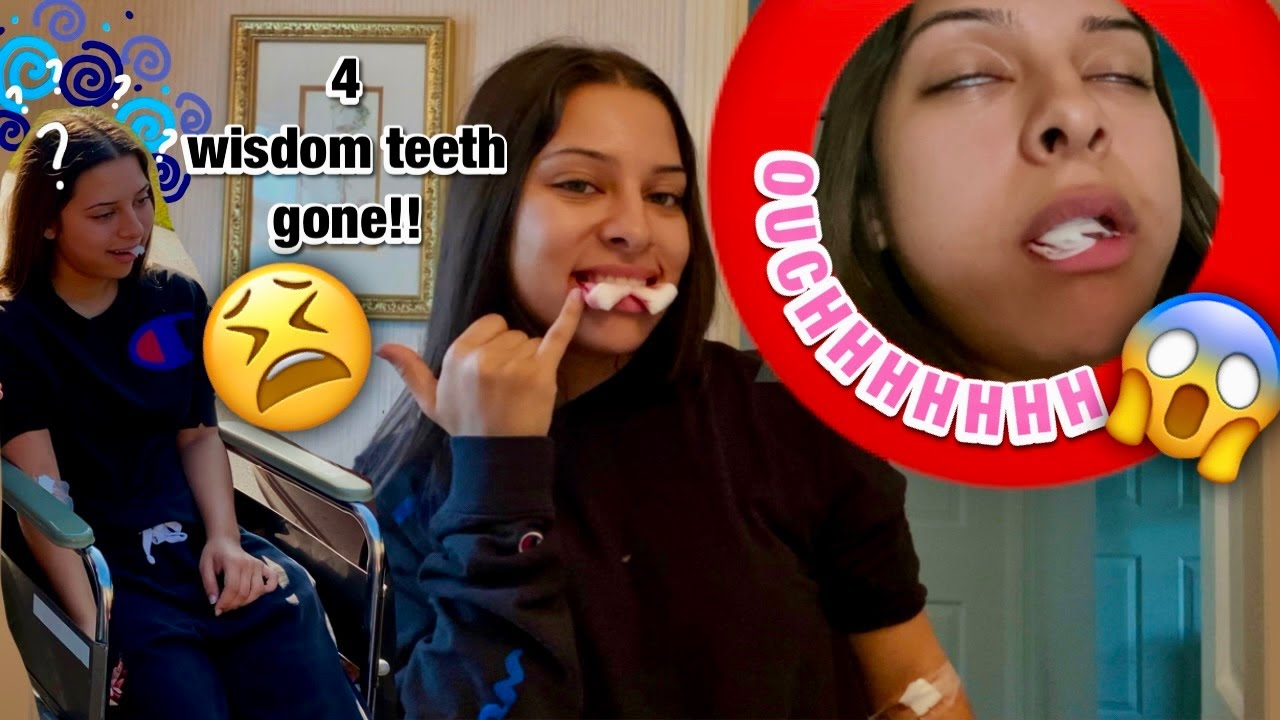 I got ALL of my wisdom teeth removed 😱 | wisdom teeth removal vlog & recovering 3 days  |Craigtivity