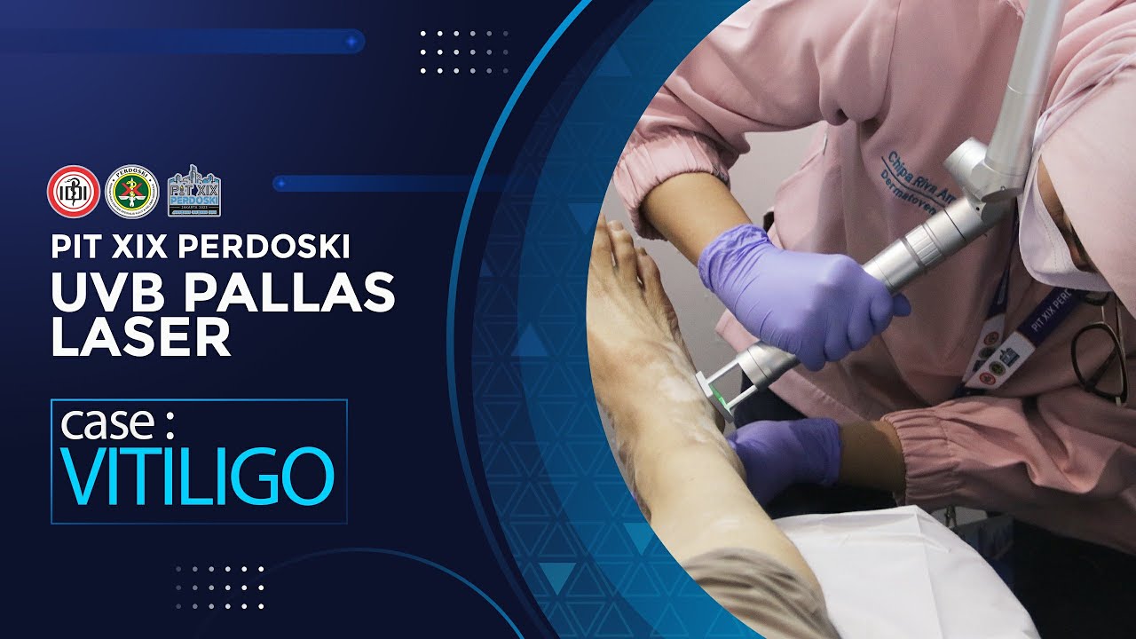 PIT XIX Perdoski Jakarta 2023 PALLAS LASER FOR VITILIGO with dr. Antoni Miftah Sp.KK, FINSDV, FAADV