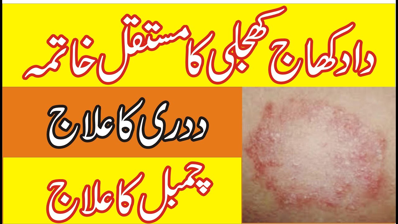 Daad ka ilaj / Daad khaj khujli ka ilaj / Chambal ka ilaj / Ringworm ka ilaj /fungal infections