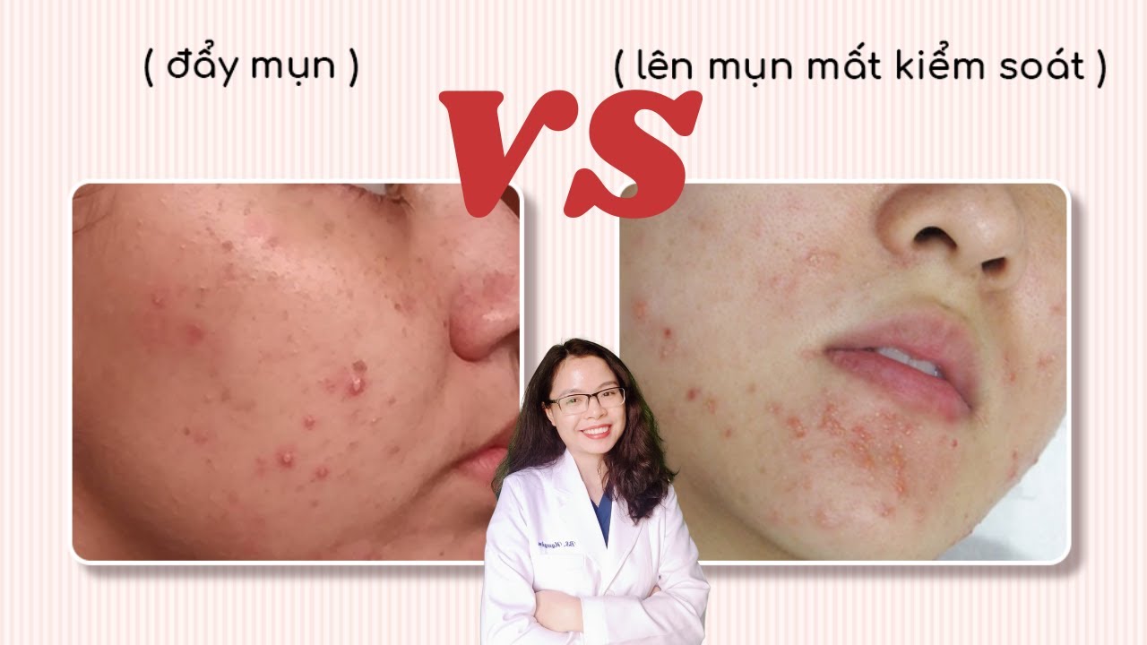 Cách phân biệt kích ứng và đẩy mụn khi dùng mỹ phẩm, retinol, bha - Xử lí tại nhà - Bác sĩ Nguyên