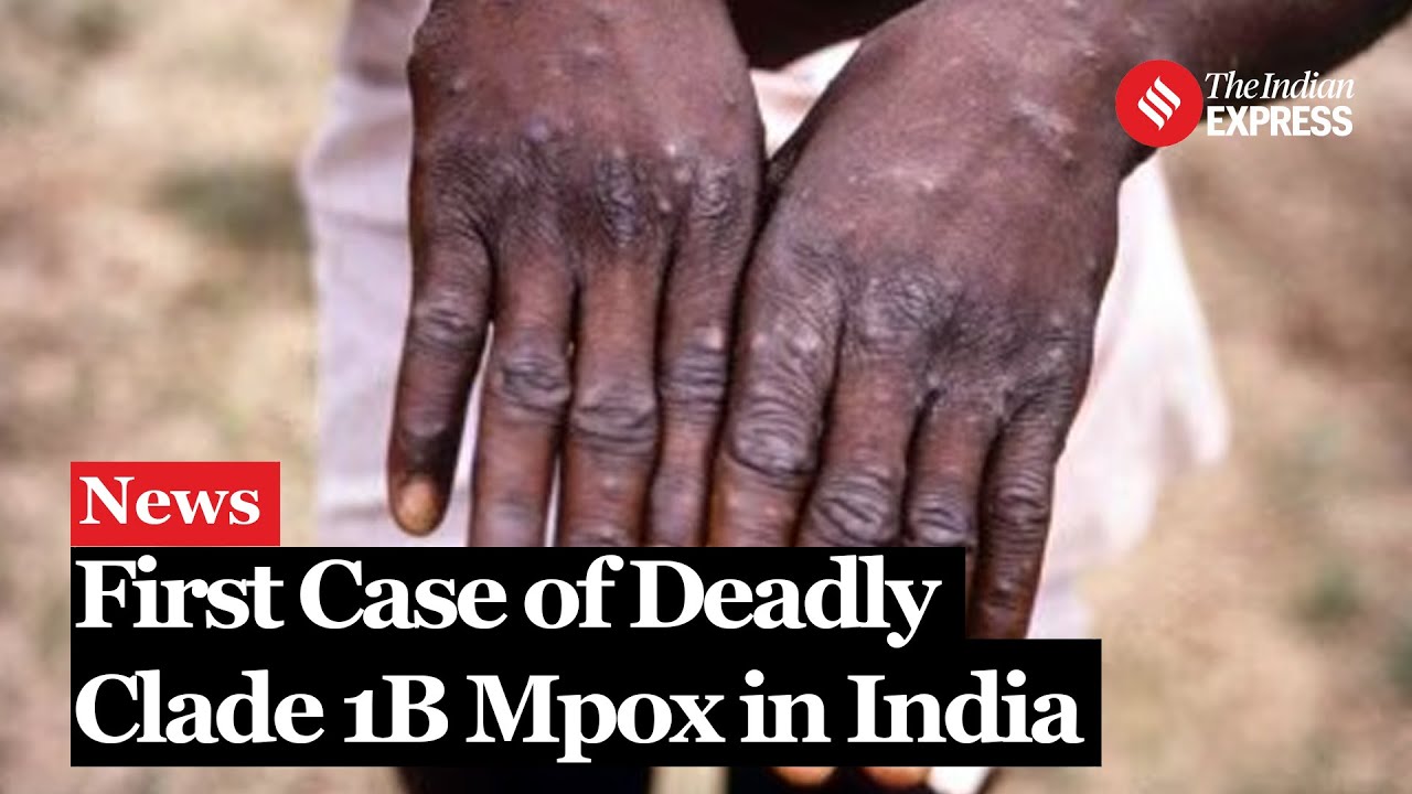 India Reports First Case of Deadly Clade 1B Mpox, Raising Global Health Concerns