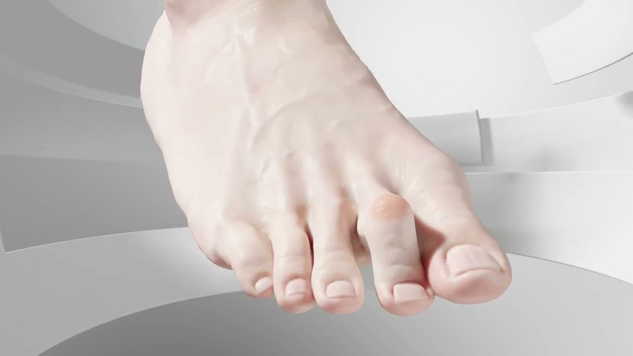 Minimally Invasive Flexible Hammertoe Surgery