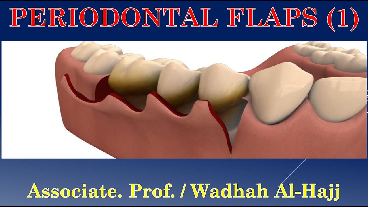 33- Periodontal surgery-2  (Periodontal flaps -1) - Dr Wadhah Periodontology lectures.د/ وضاح الحاج