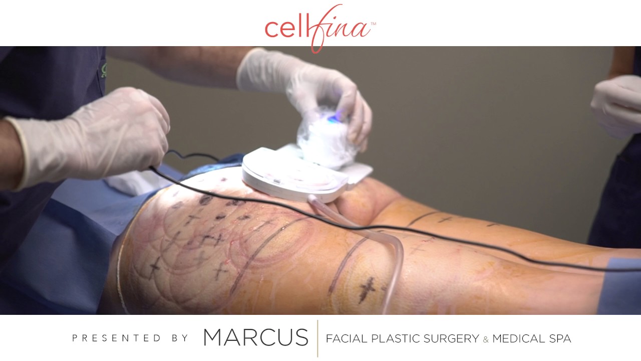 New Cellulite Treatment | Cellfina
