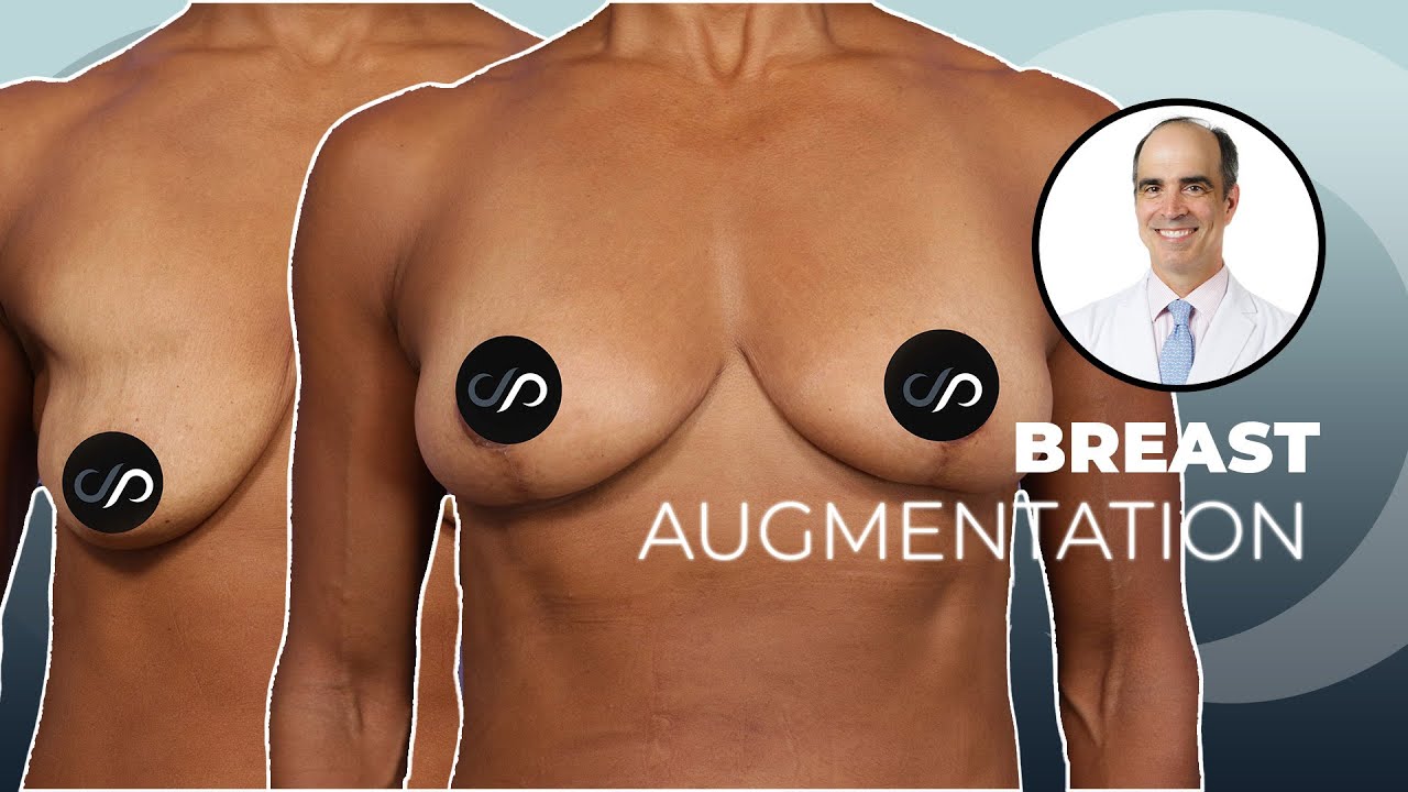 Female Breast Lift | Before & After | Los Angeles