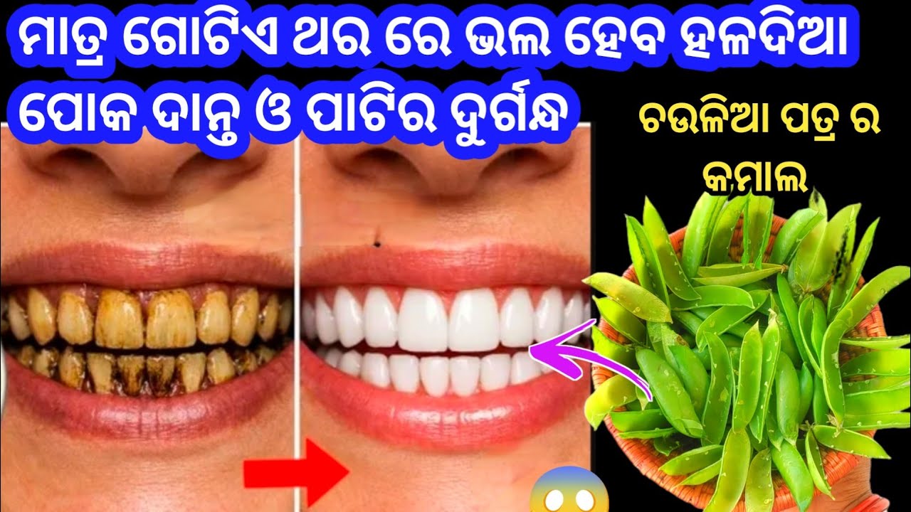 ଗୋଟିଏ ଥର ରେ ଭଲ ହେବ👉 ଦାନ୍ତ ବିନ୍ଧା, ଗନ୍ଧିଆ ପୋକୋଡା ଦାନ୍ତ, ପାଟିର ଦୁର୍ଗନ୍ଧ ଓ ବହୁ ସମସ୍ୟା।odiakitchentips 