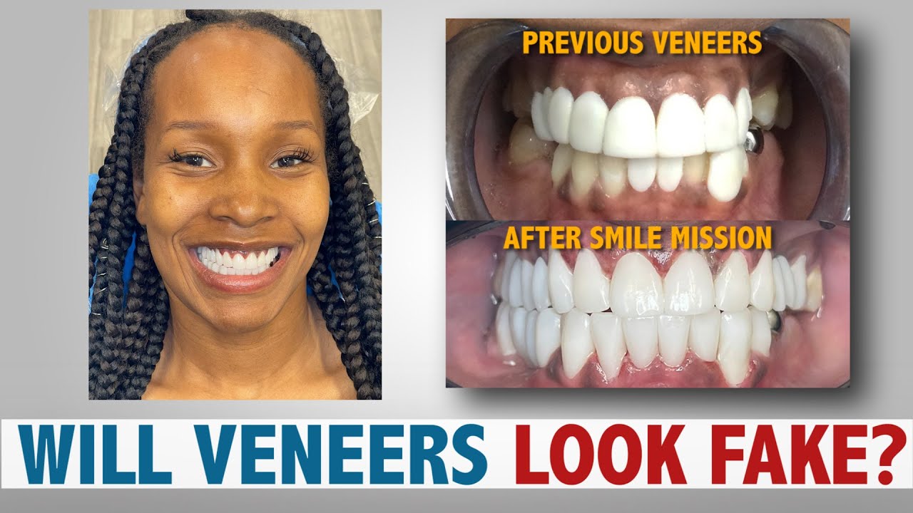 Will Veneers Look Fake?