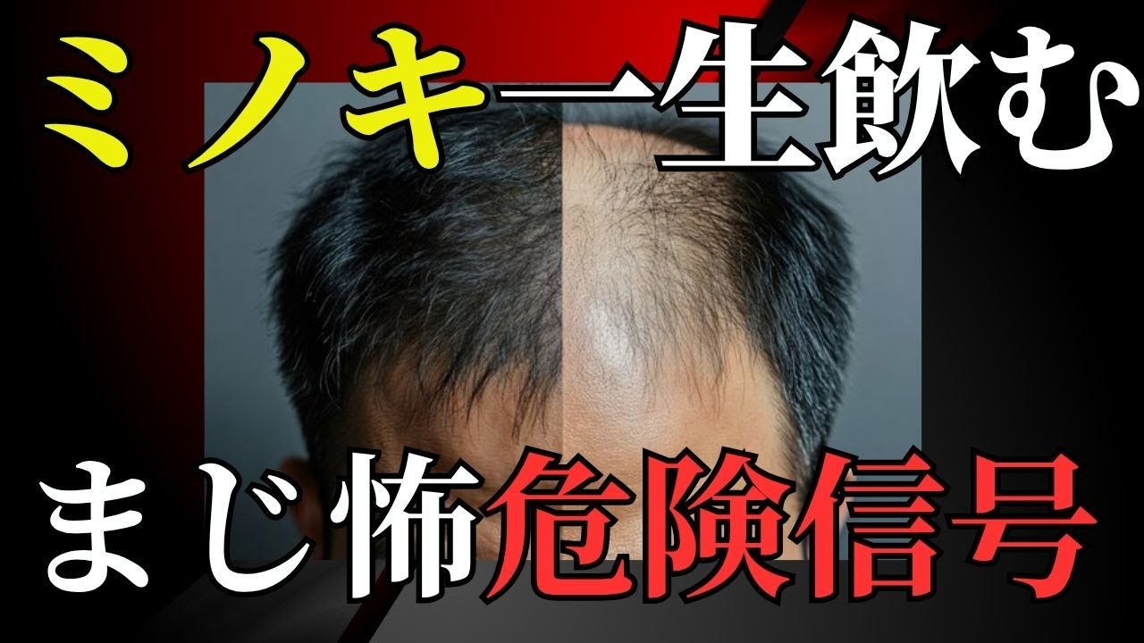 【一生沼】ミノキシジルを飲み始めた人の末路について