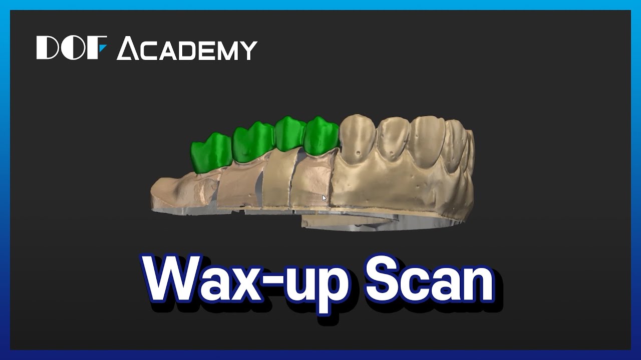 Wax-up Scan