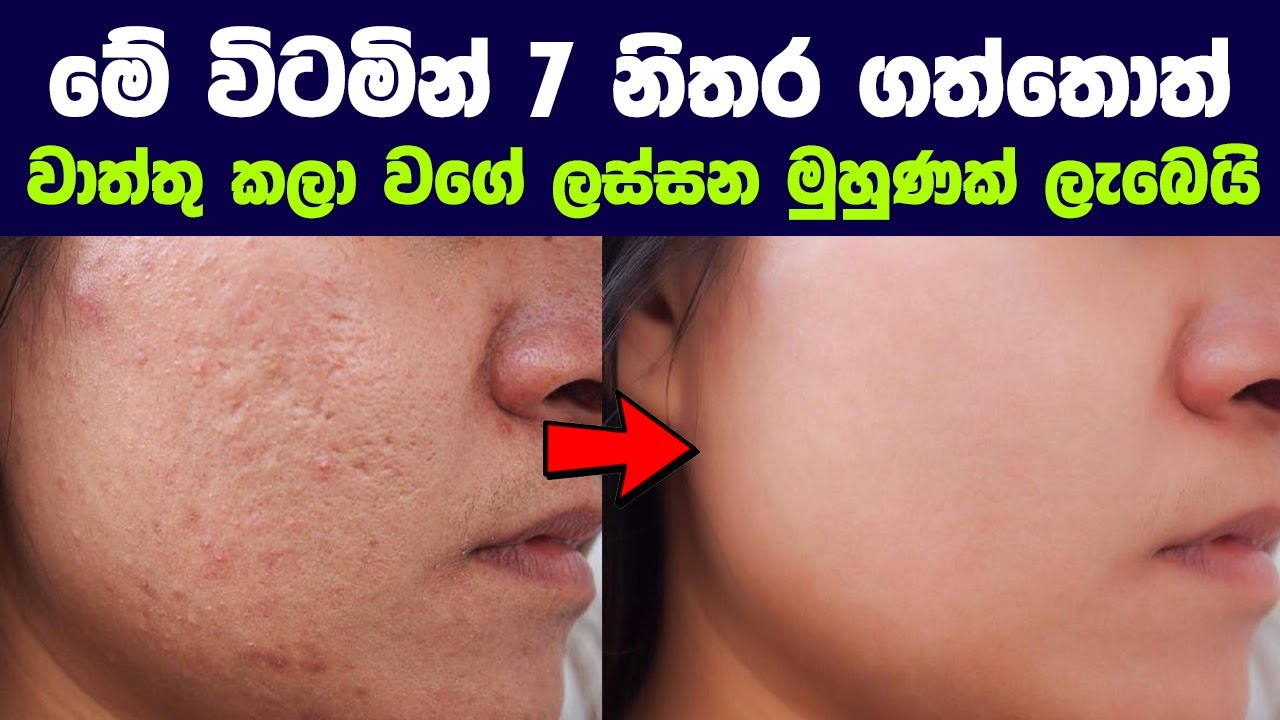 මේ විටමින් 7 නිතර ගත්තොත්, වාත්තු කළා වගේ ලස්සන මුහුණක් ලැබෙයි | The Most Powerful Skin Vitamin