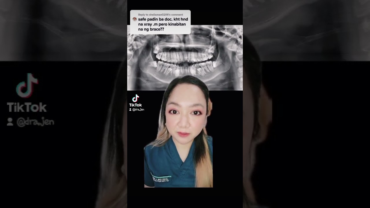 Bakit kelangan ng panoramic xray bago maginstall ng braces? (Impacted Tooth)