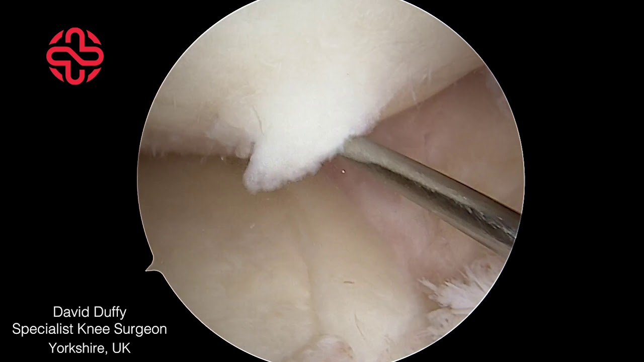 Unstable Articular Cartilage Flap