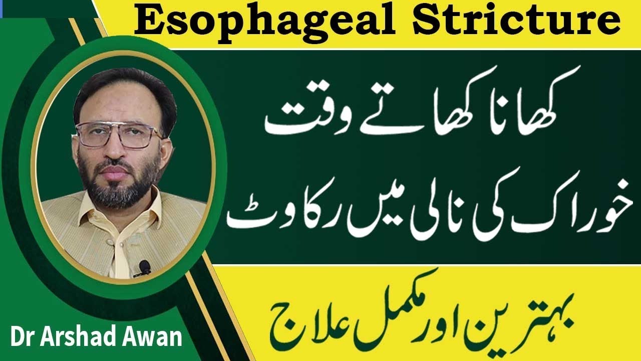 Esophageal Stricture Causes,Symptoms And Treatment In Urdu | Dysphagia Problem Treatment In Urdu
