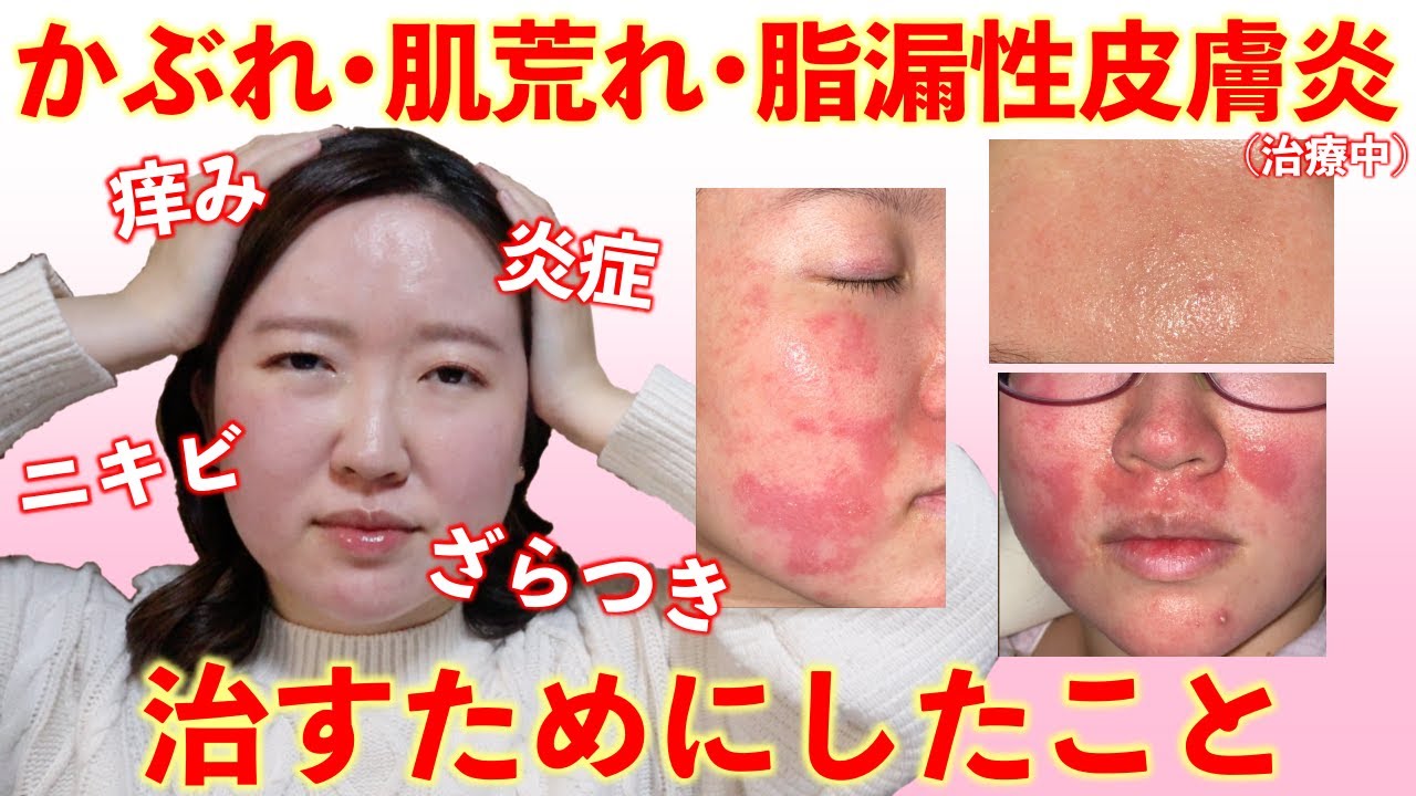 かぶれ•謎の肌荒れ•脂漏性皮膚炎を治した方法💡家でできる対処法•薬•メイクなど全てお伝えします！