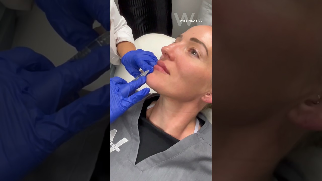 Restylane Kysse Lip Fillers