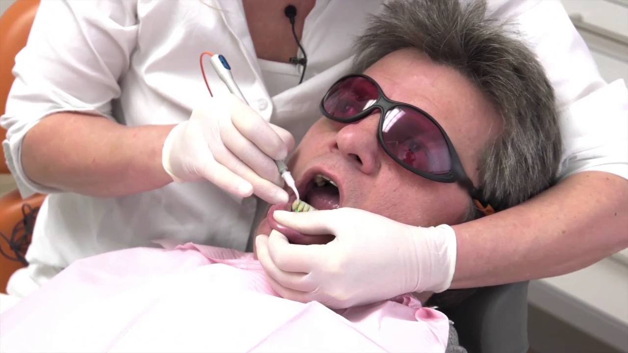 Parodontitisbehandlung mit dem Laser (Laserbehandlung bei Zahnfleischentzündung) Teil 1