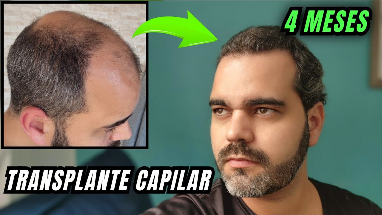 4 meses após meu TRANSPLANTE CAPILAR. Resultados, Efeitos colaterais e Opinião Sincera
