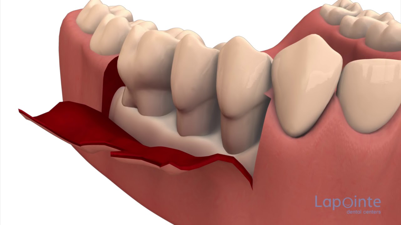 Flap Surgery/Pocket Reduction Surgery