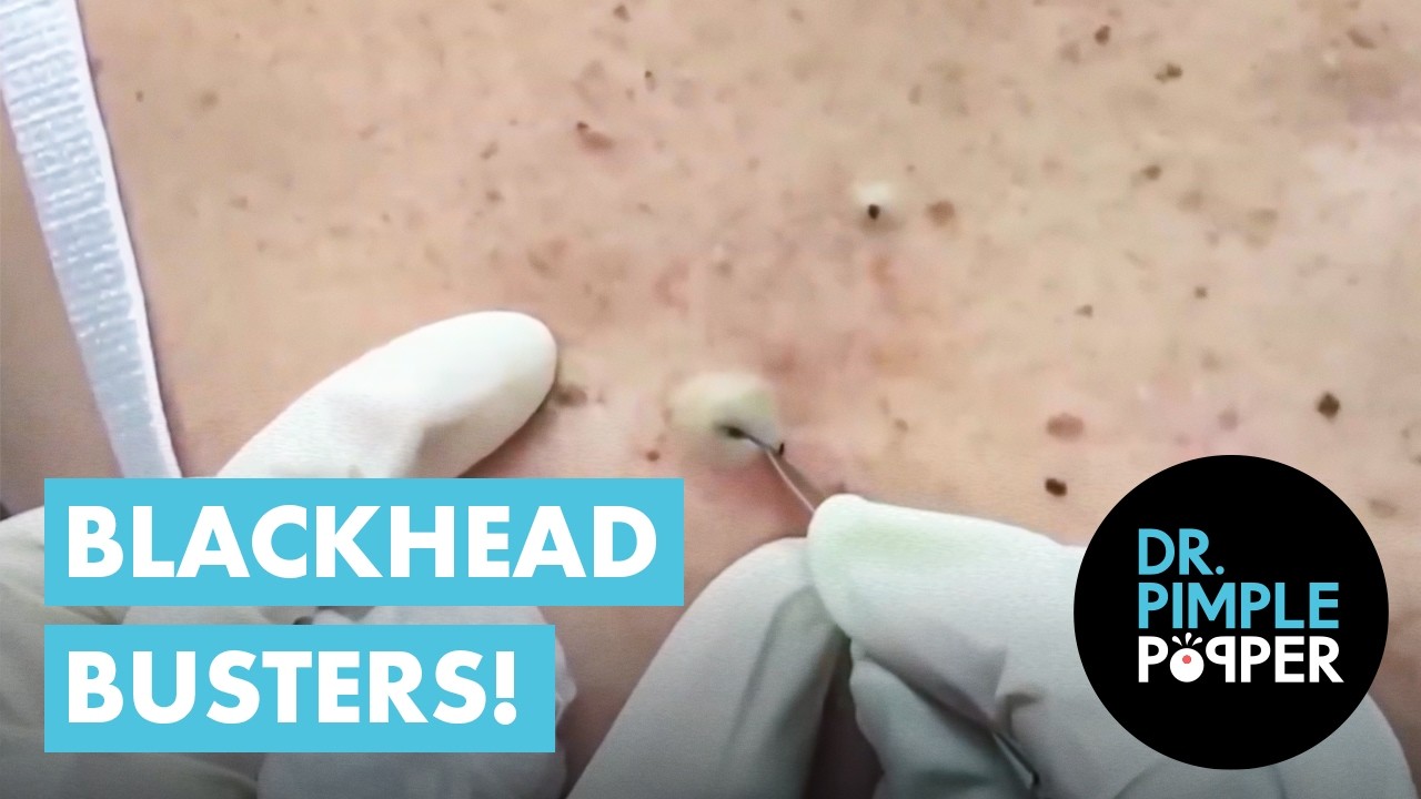 Blackhead Busters!