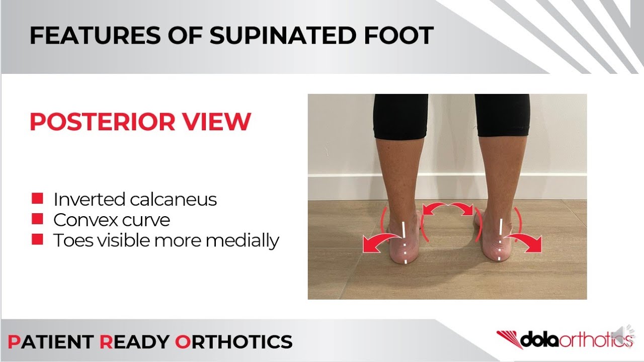 Orthotic selector Features of Supinated Foot