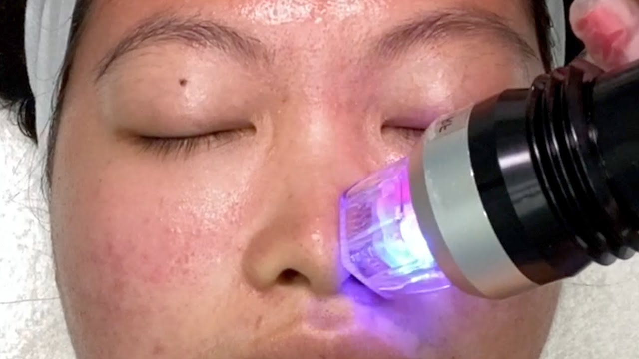 I Tried Microneedling RF for Acne Scars (Before and After) | East Asian Skin