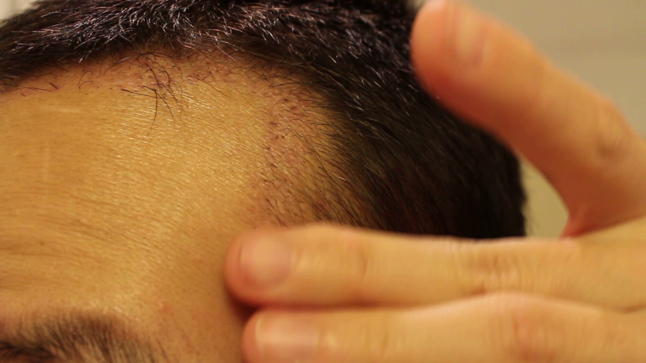 Day 54 - FUE Hair Transplant Surgery 1700 Grafts Post Op