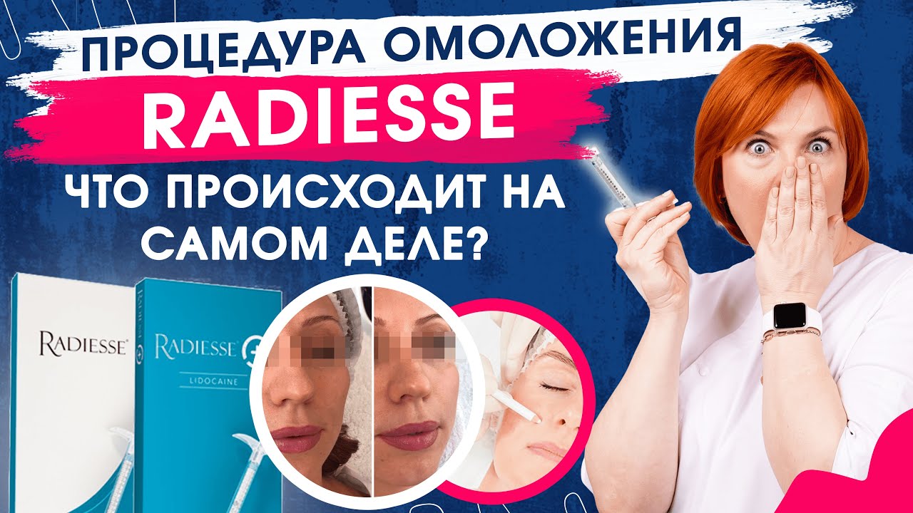 RADIESSE  омоложение.Что происходит на самом деле?Контурная пластика филлером Радиесс.