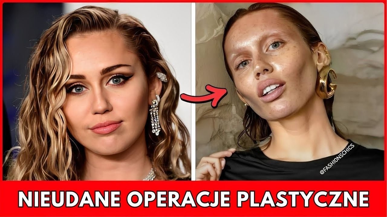 7 celebrytów uzależnionych od operacji plastycznych – szokujące metamorfozy