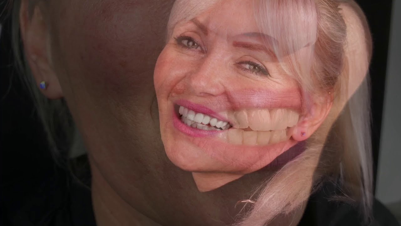 Zubne krunice od A do Z