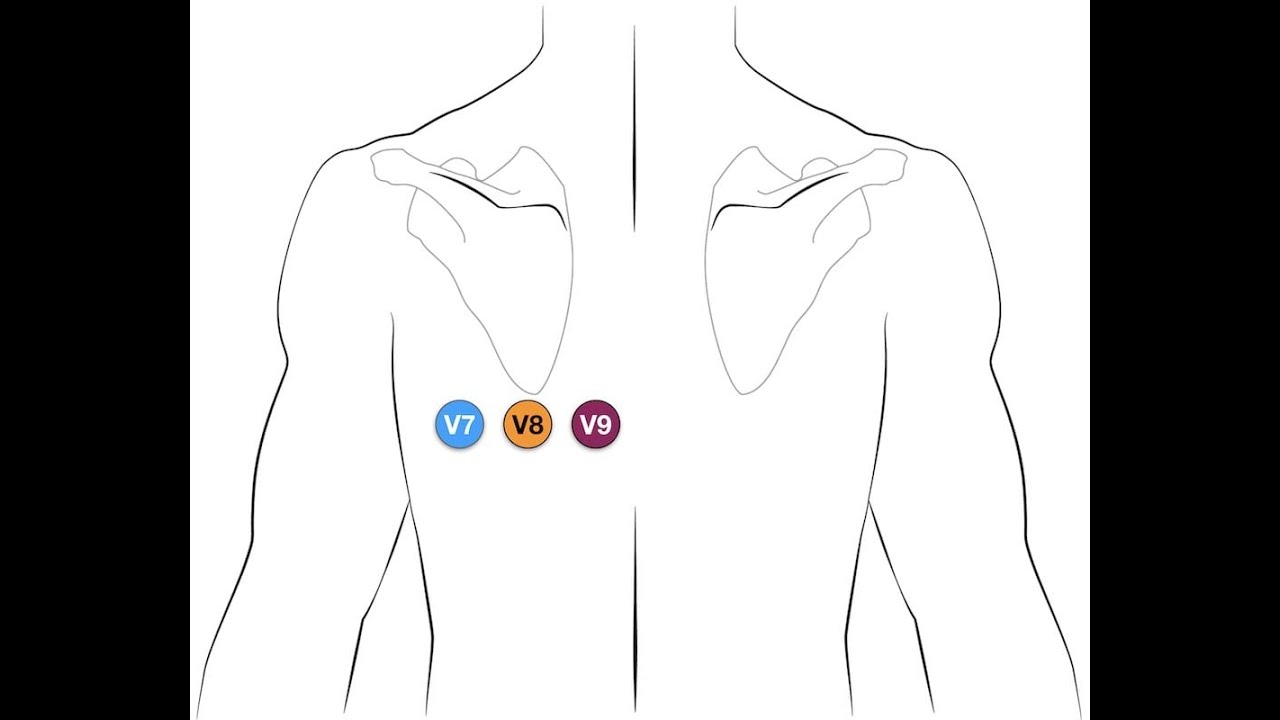 posterior myocardial infarction