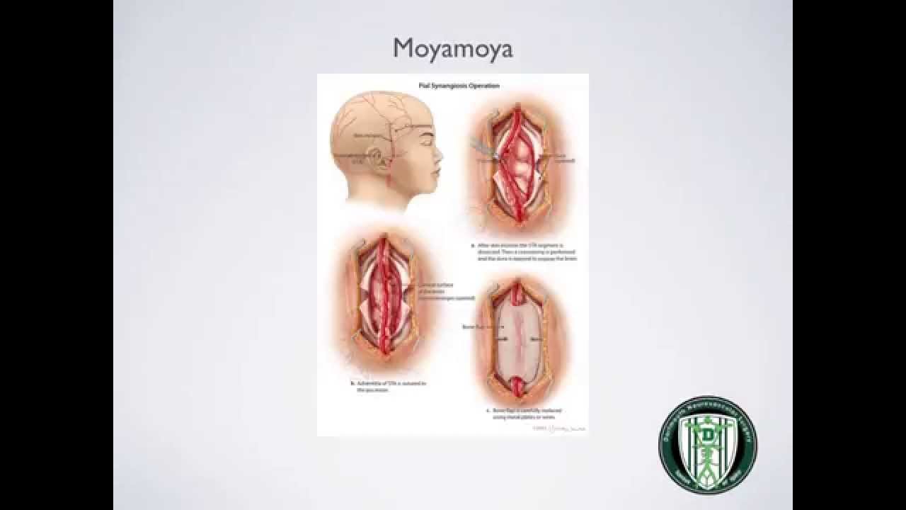 CTH Moyamoya