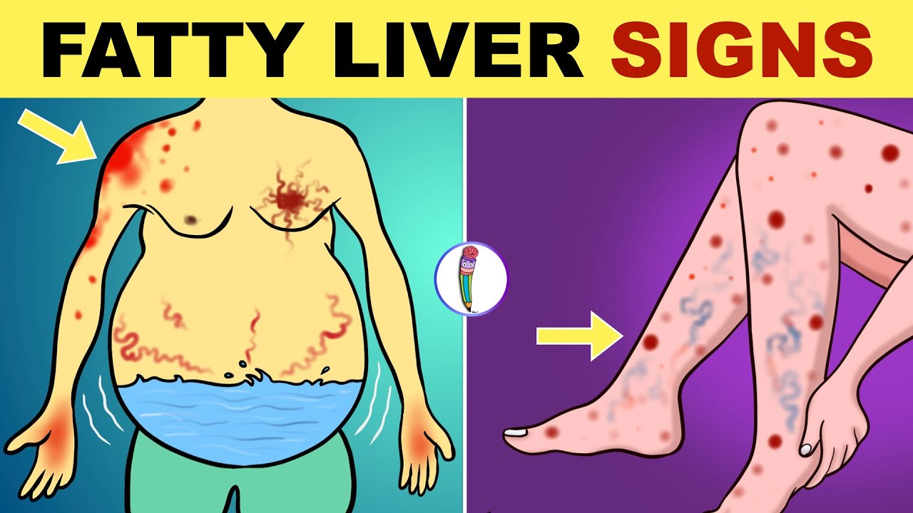 Fatty Liver Symptoms | Early Signs of Fatty Liver Disease | Non Alcoholic Fatty Liver Disease