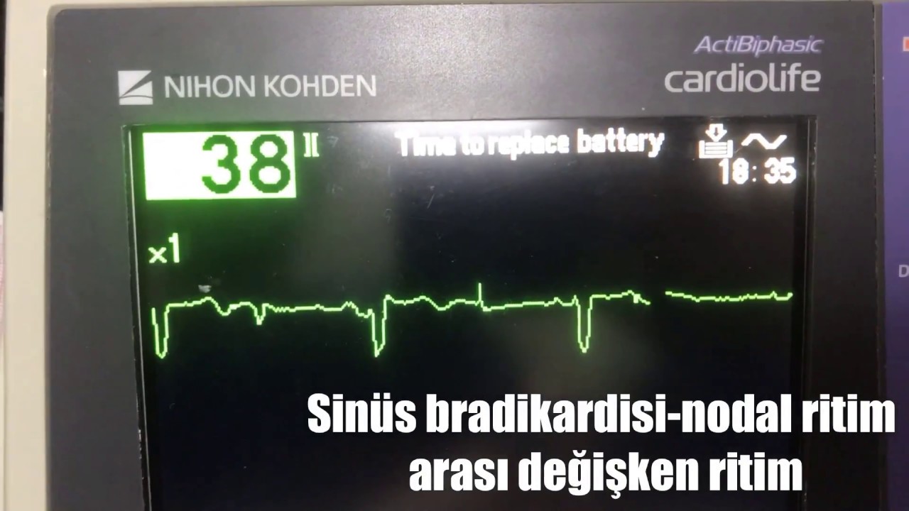 SİNÜS BRADİKARDİSİ-NODAL RİTİM ARASI DEĞİŞKEN RİTİM