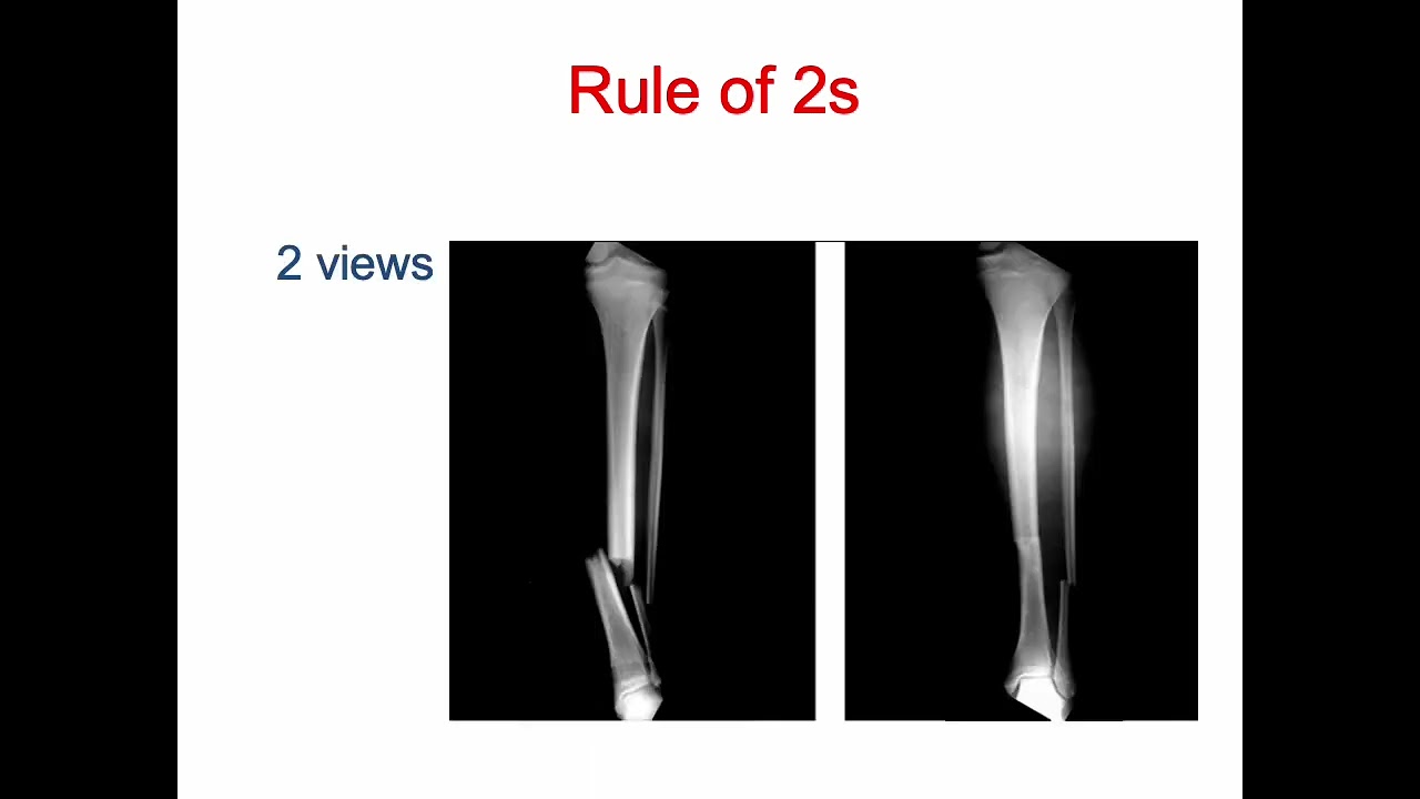 MSK 1   Fracture Basics