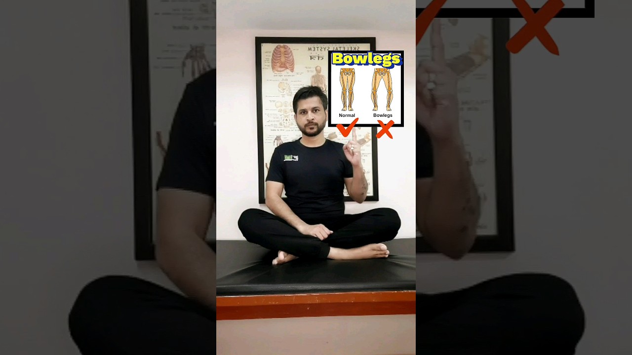 Best Exercise for Bowlegs..
