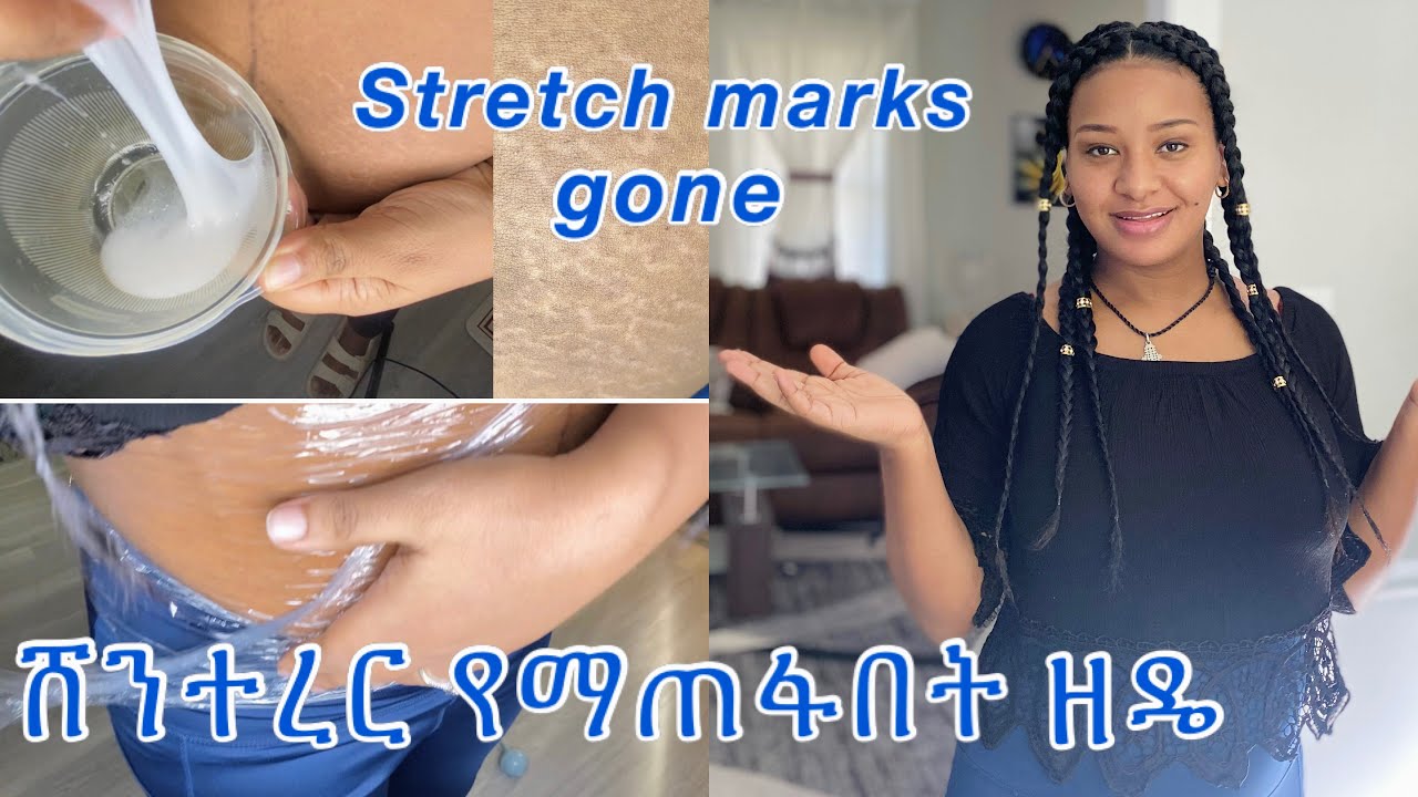 ⭐️የሰውነት ሸንተረር የማጠፋበት ዘዴ ለማንኛውም ቦታ እና ከወሊድ በኃላ የምጠቀመው// The best stretch mark remover￼