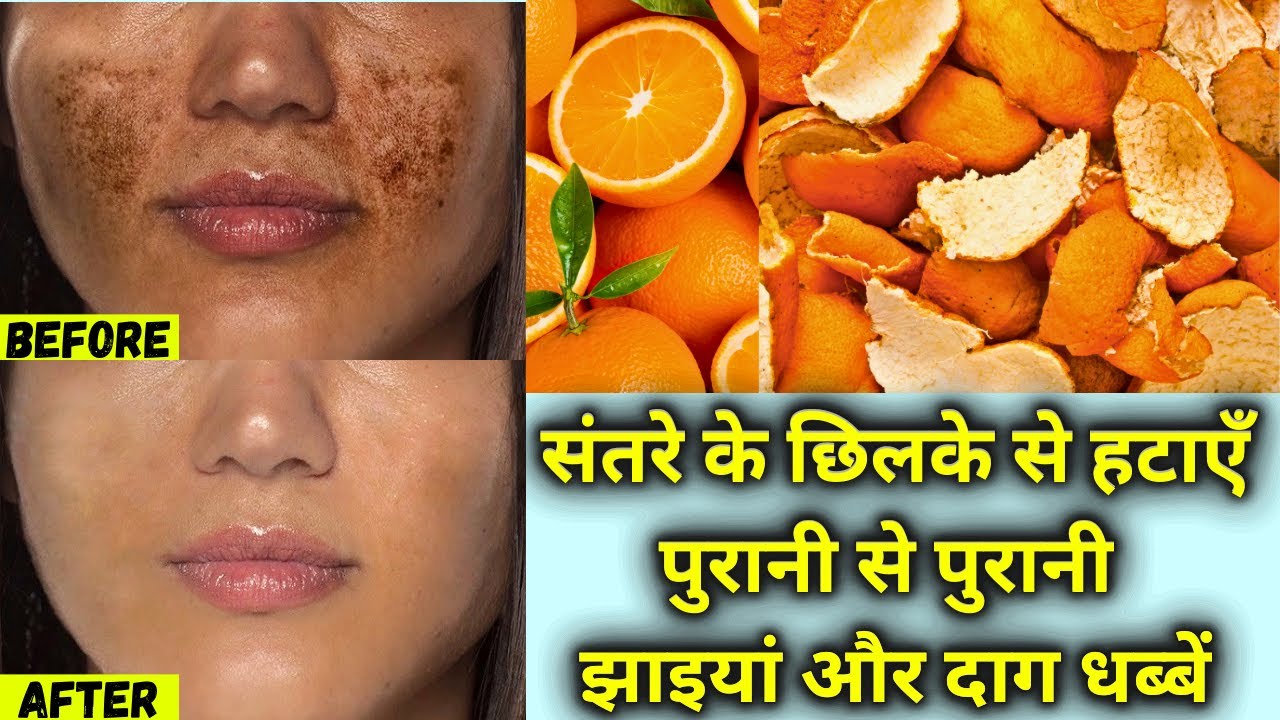 संतरे के छिलके से झाईयां हटाने का कमाल का तरीका | Remove Pigmentation, Dark Spots, Melasma