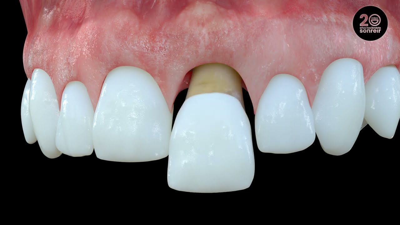 Implante Inmediato Con Tejido Conectivo - Clínica Dental Patricia Aneiros