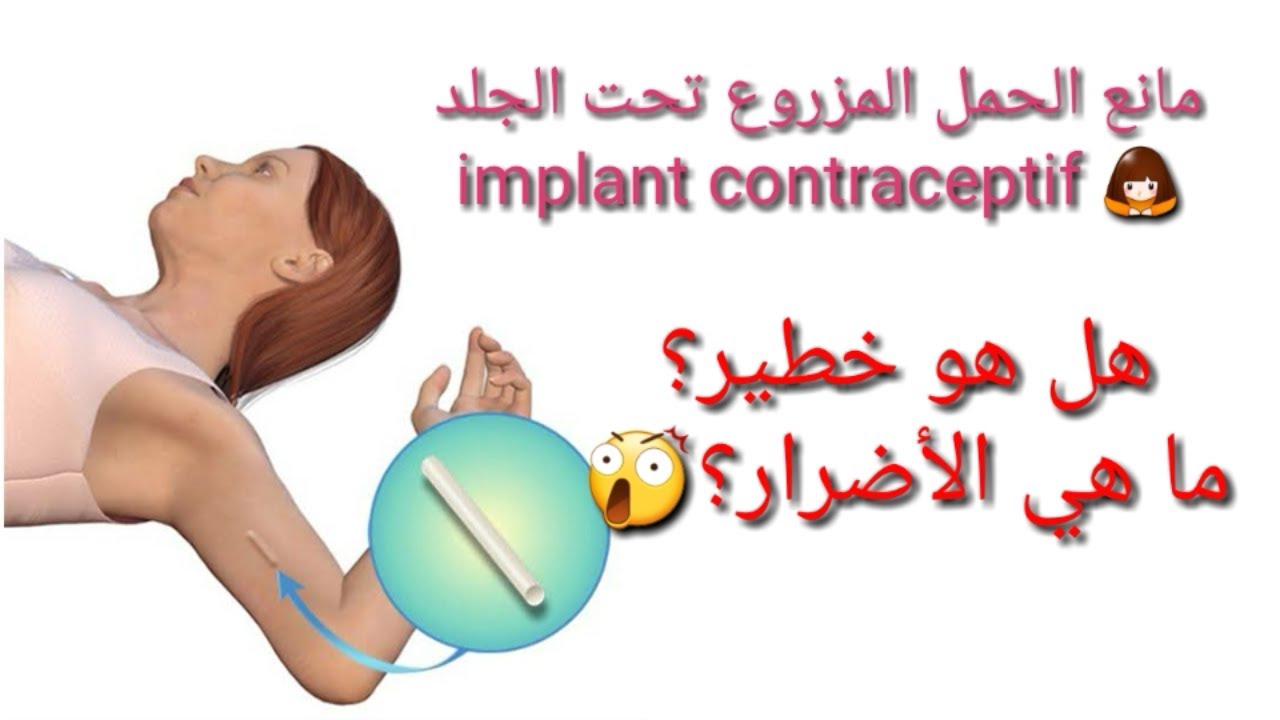 l'implant contraceptif حبيتي تديري شريحة منع الحمل تحت الجلد و راكي خايفة 😩دخلي هنا