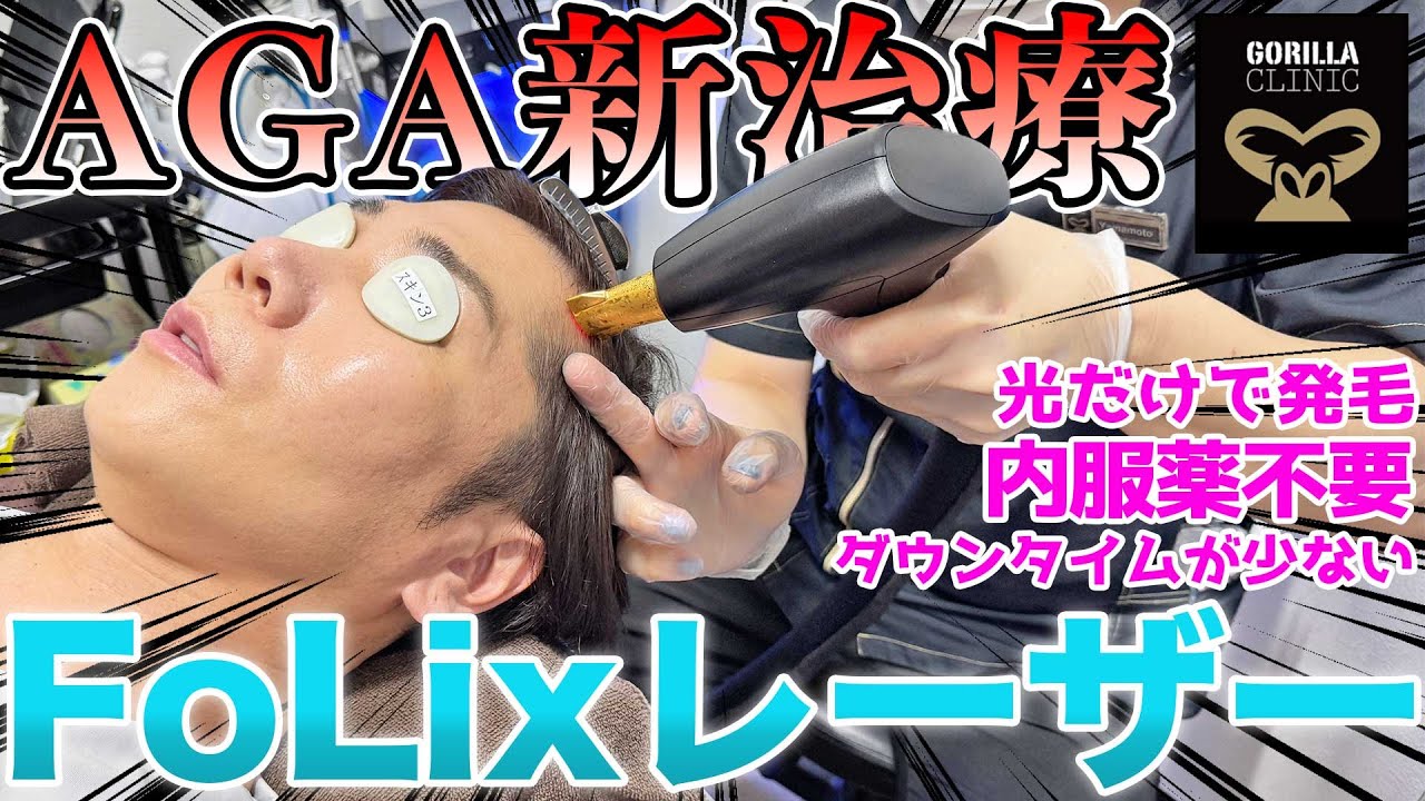 【最新AGA医療】薬飲まずに効果あり、痛みなし！【フォリックスレーザー】