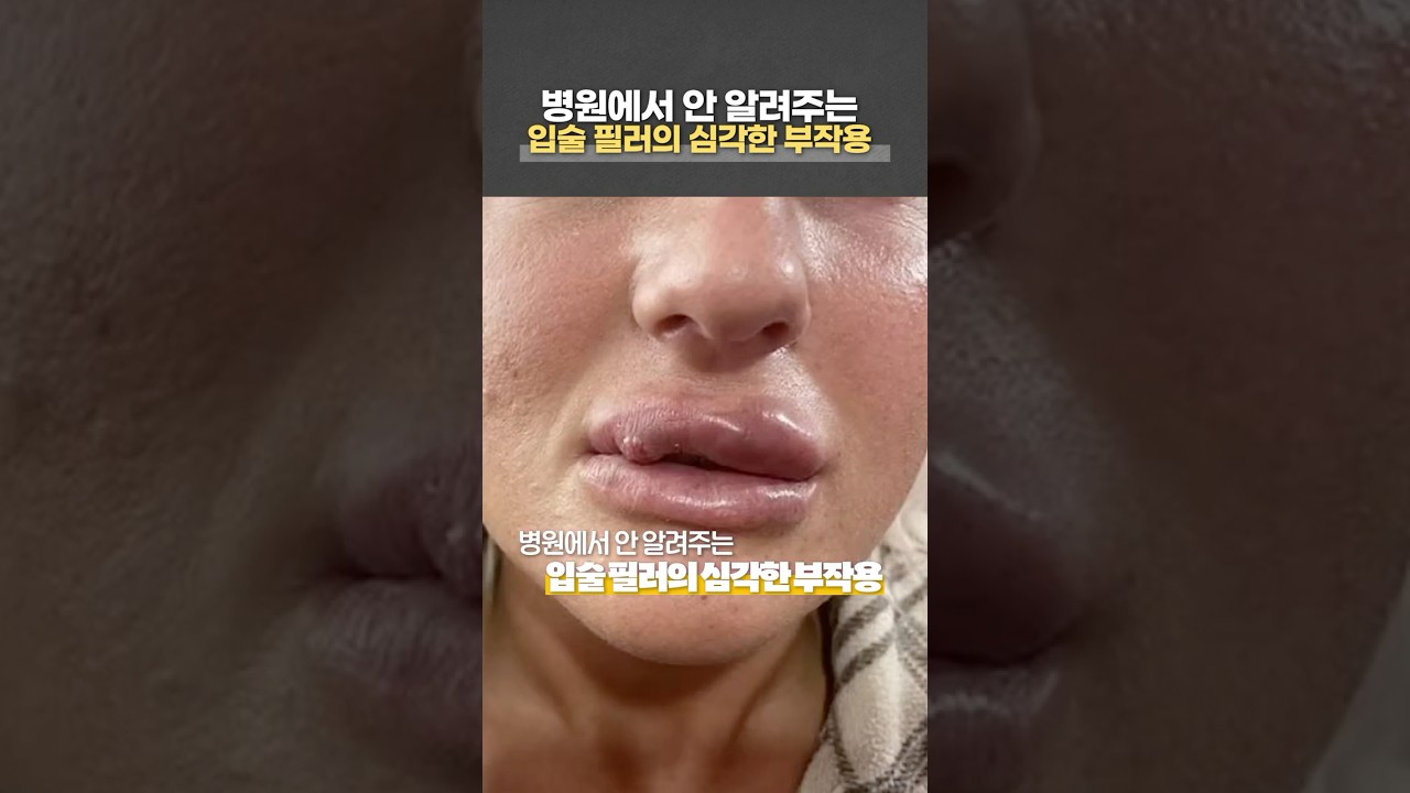 대부분 모르는 입술 필러의 심각한 부작용