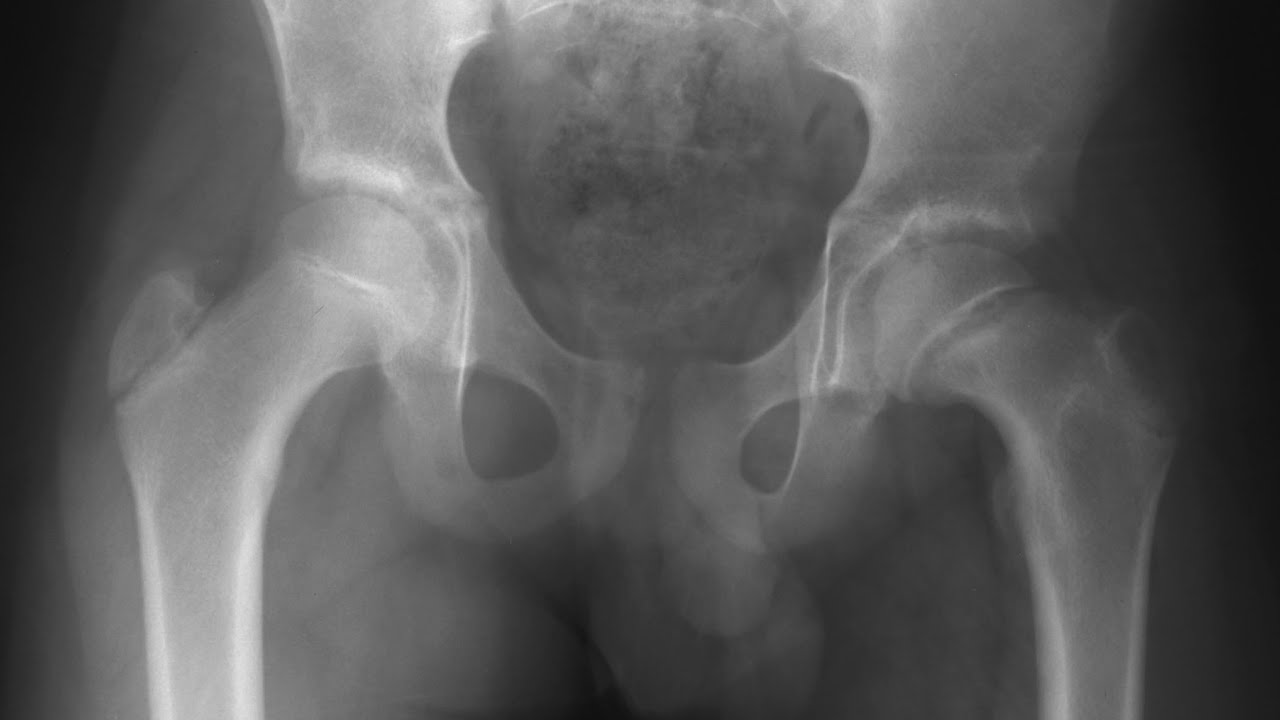 Age estimation by x rays( forensic medicine)