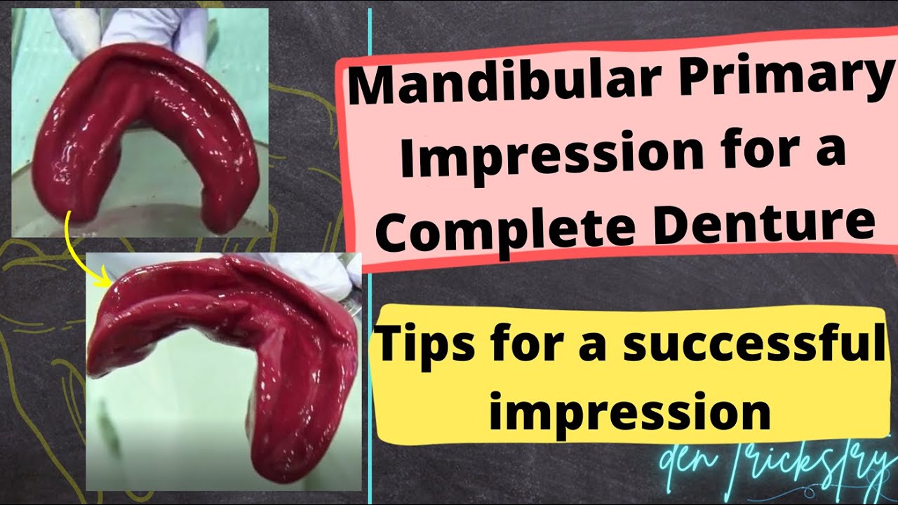 Mandibular Primary Impression for an Edentulous Patient (Complete Denture Impression)