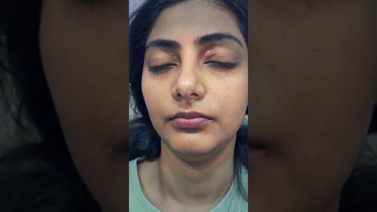 Best xanthelasma treatment in Kolkata #youtubereels #youtubeshorts #youtubevideo #kolkatafashion
