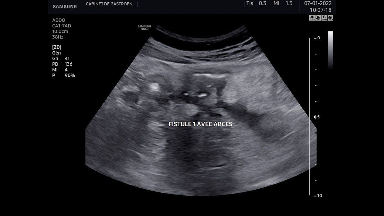 Echographie digestive maladie de Crohn fistules abcès  Crohn's disease, abcess, fistula, ultrasound
