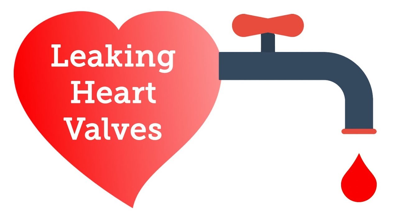 Cardiologist Q&A: Do Leaking Heart Valves Require Surgery?