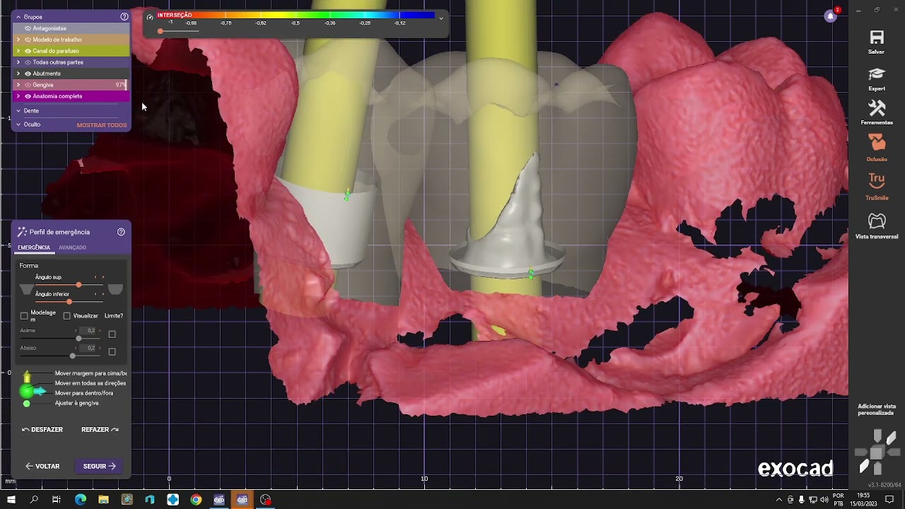Exocad cad cam fazendo furo na coroa para implante sobre munhão personalizado